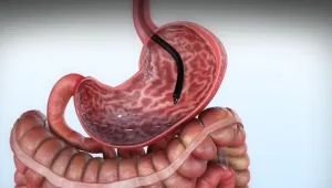 בפעם הראשונה בישראל: קיצור קיבה – ללא ניתוח