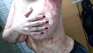 אובחנה במחלה המכסה את גופה בכתמים והחליטה לחשוף אותה באינסטגרם בגאווה