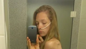 אנורקסית שחיה מ-100 קלוריות ביום מתעדת את מסע ההחלמה שלה