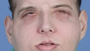 נחשפו פניו של מושתל הפנים שנשרף בעבודתו, הוא קיבל את פניו של בן ה-26 שנהרג מתאונת אופניים