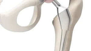 הדפסת מפרקים במדפסת תלת מימד