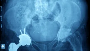 חיים בריא: מהו סרטן אורתופדי, ואיך מטפלים?