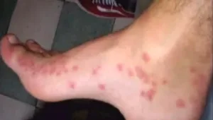 שוק הפישפשים: רשתות האופנה בניו יורק נלחמות בפישפשי המיטה