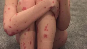 התמלאה בכתמים אדומים בכל גופה וזה מה שהיא גילתה