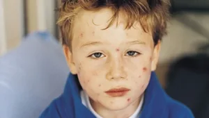 אדמומי ומגרד: הכל על אבעבועות רוח