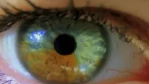 חיים בריא: מלחמת הלייזר בקטרקט