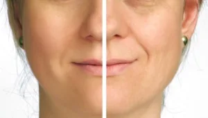 חיים בריא: צניחת עפעפיים במבוגרים