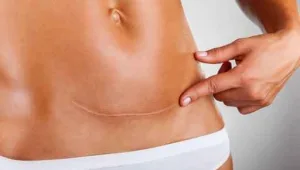 חיים בריא: טיפול בצלקות