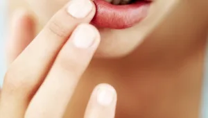 חיים בריא: טיפול בהרפס