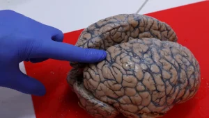 חיים בריא: האם נמצא טיפול לסרטן המוח?