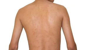 חיים בריא: טיפול בכתמי שמש