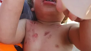 אישום: תינוק נכווה מחומרי ניקוי - המטפלת הסתירה מההורים