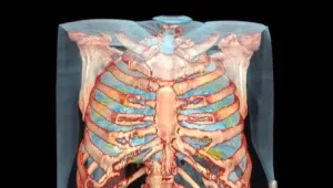 הצצה: כך נראות ריאות של חולה קורונה