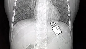 דרמה בחדר הניתוח: בן 6 בלע מנעול - והובהל לניתוח יוצא דופן