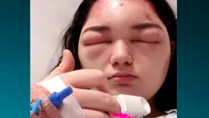 נערה בת 16 צבעה את שיערה בבית - והובהלה לביה"ח במצב קשה