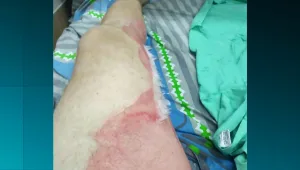 אלעד מאושפז עם כוויות בדרגה 2 לאחר שבקבוק החימום שלו התפוצץ