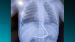 פעוט בן שנתיים בלע 36 כדורי מגנטים וניצל בנס בניתוח מורכב