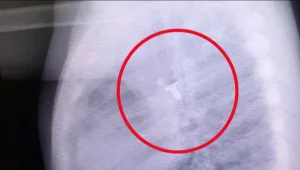 תוך שבועיים: 5 פעוטות הובהלו לביה"ח לאחר שבלעו חפצים מסוכנים