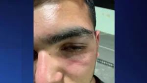 נער בן 16 הותקף באכזריות: "בגלל שחבשתי כיפה"