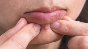 זאת הסיבה שאסור שתפוצצו לעצמכם פצעונים בפנים