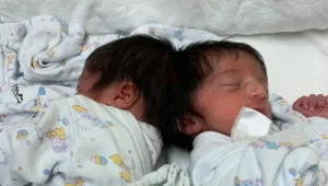 לראשונה בישראל: ניתוח נדיר להפרדת תאומות המחוברות בראשן