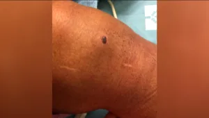 הבילוי במרפסת נגמר בקליע m16 שנתקע ברגלה של קשישה