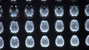 סערת ה-MRI: במשרד הבריאות אישרו לחברת ביטוח לאפשר תור מהיר, למרות שאין דחיפות רפואית