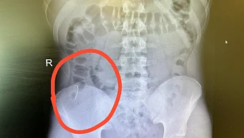 חשש לניקוב איברים פנימיים: נער בלע בטעות סיכה - חייו ניצלו בזכות הליך פולשני