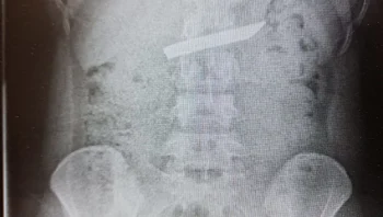 "מזל גדול": סכין באורך 9 ס"מ שנבלעה בטעות - הוצאה מקיבתה של בת 18