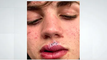 15 נגד אחד: במהלך משחק כדורגל - בן 14 הותקף על ידי 15 נערים