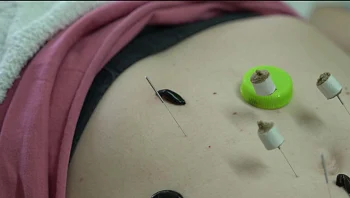 עלוקות, דבורים ואמבטיית קרח: עד כמה רחוק נגיע כדי לטפל בגוף שלנו?