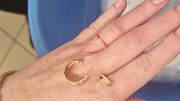 באישון לילה: הזעיקה לוחמי אש לחילוץ טבעת נישואין מהאצבע