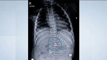 בת שנה הובהלה לביה"ח לאחר שבלעה מגנטים - וניצלה בנס