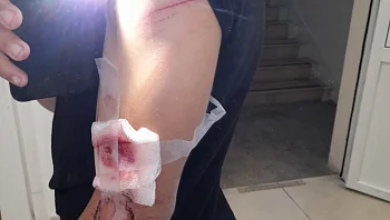 שני אחים הותקפו ע"י עשרות ערבים בעכו: "זה היה מאורגן מראש"