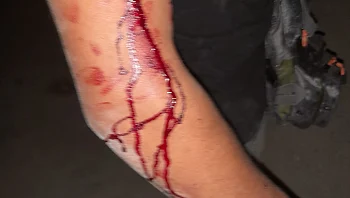 במקלות ובסכין: שני אחים מעכו הותקפו ע"י עשרות נערים