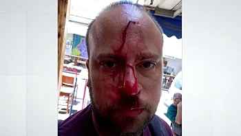 העיר לבעלי כלב משוטט שתקף את כלבו - והותקף באלימות בפטיש