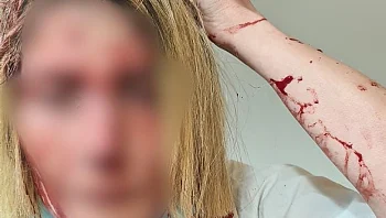 "כל המרפאה התמלאה בדם": הרופאה שהותקפה עם פטיש משחזרת