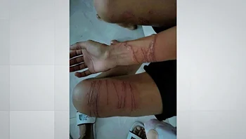 הצעיר שהחליק לתוך נחיל מדוזות - ונעקץ בגל גופו