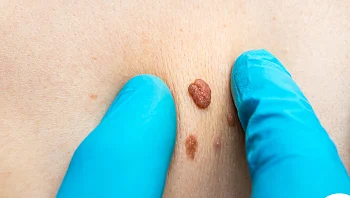 ה-FDA מזהיר: הימנעו משימוש בתכשירי הסרת שומות