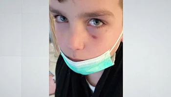 בן 10 הותקף באגרופים ע"י תלמידים בביה"ס: "סובל כבר שנתיים"