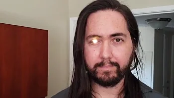 פנס בעין: אדם הפך את עינו לפנס לאחר שאיבד אותה כשחלה בסרטן