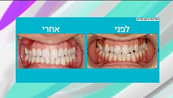 פתרונות חדשניים לשיפור החיוך בטיפול מהיר