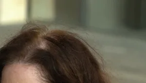 מבחן הקרחת: האם הטיפולים החדשניים נגד איבוד שיער עובדים?