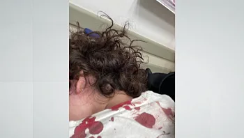 בת 3 נפצע מספריי שלג שהושלך לעברה: "העגלה התמלאה דם"