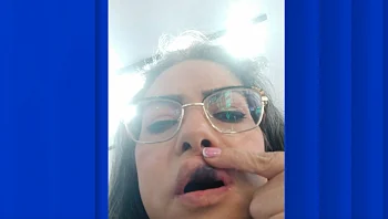 סיוט בטורקיה: טסה כדי לקבל חיוך מושלם - וחזרה בלי שיניים 