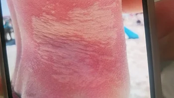 מקרה חריג: צעיר פונה לבית החולים לאחר שנצרב בצורה קשה ממדוזה