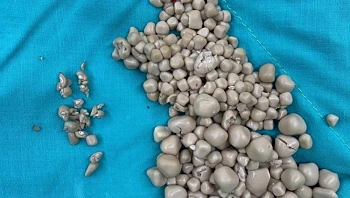 למעלה מ-300 אבנים בכליות של צעירה שהעדיפה לשתות משקאות מתוקים במקום מים