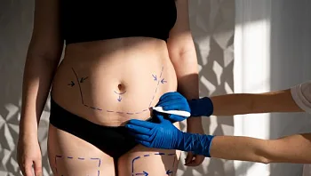 מתיחת בטן - שיטות טיפול ואיך זה מתבצע? מדריך מקיף