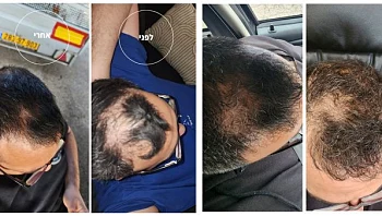 האם התוסף תזונה של הרמוני לנשירת שיער באמת עובד? יצאנו לבדוק