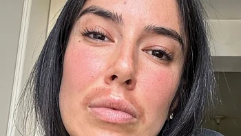 יוצאת "האח הגדול" מאשימה את אדל בספלוב בכוויות בפנים